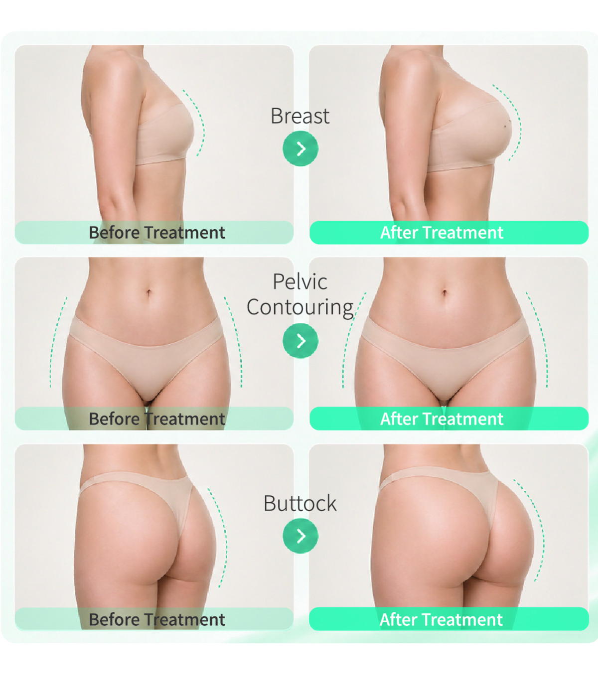Lumeezy Body Filler before and after treatment examples